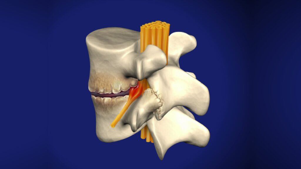 neck and shoulder pain