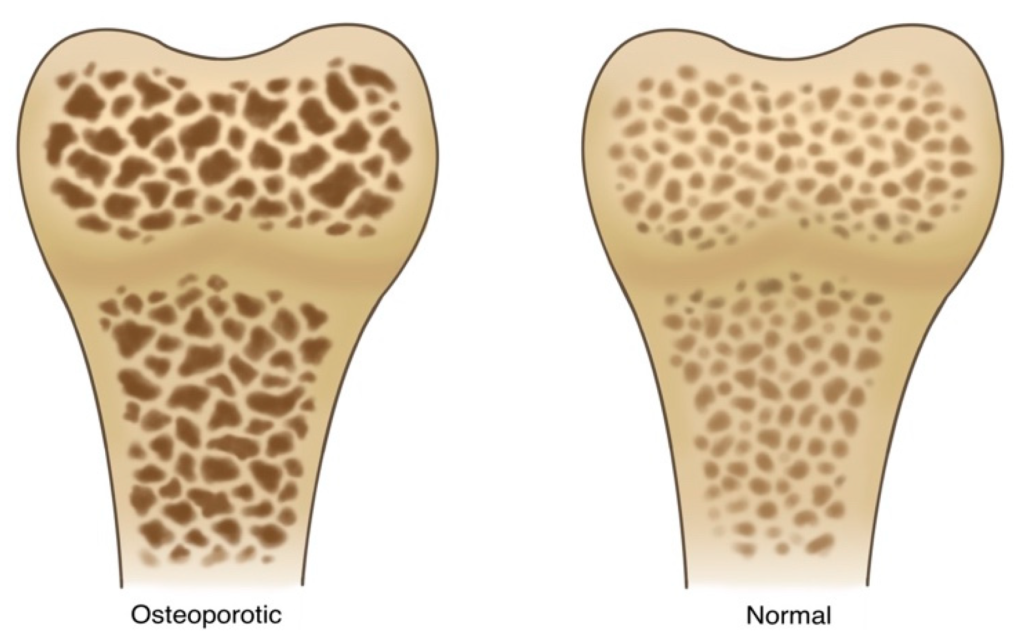 Osteoporosis