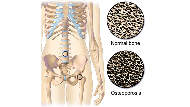 Osteoporosis