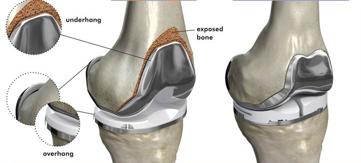 Knee Osteoarthritis