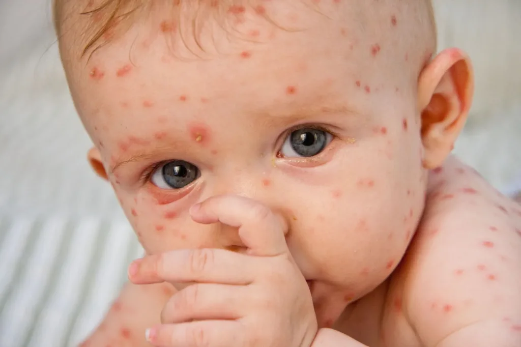 Chickenpox (Varicella) is a highly contagious infectious disease with the potential to cause large-scale epidemics. The primary clinical manifestation is a vesicular rash on the skin and mucous membranes.