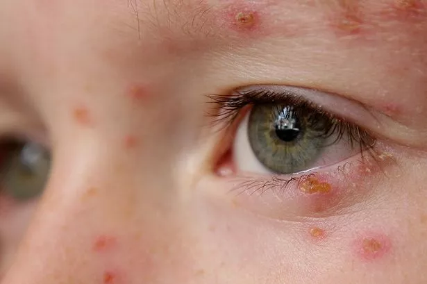 Chickenpox (Varicella) is a highly contagious infectious disease with the potential to cause large-scale epidemics. The primary clinical manifestation is a vesicular rash on the skin and mucous membranes.