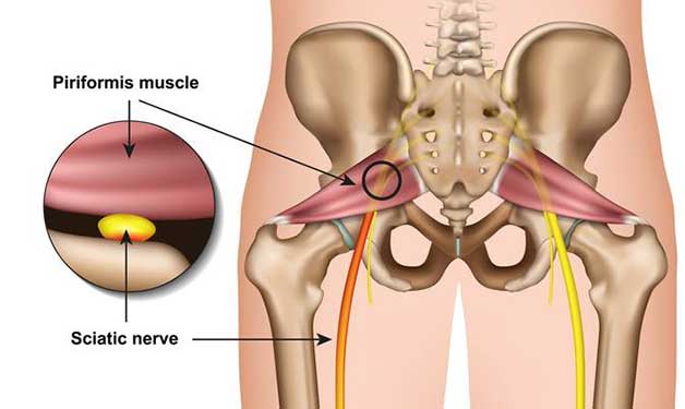 Sciatica Pain