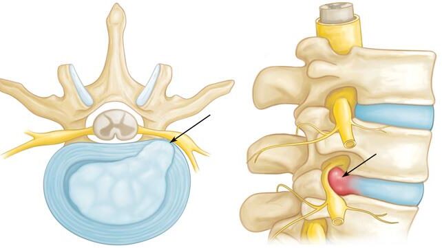 Cervical scapulohumeral syndrome