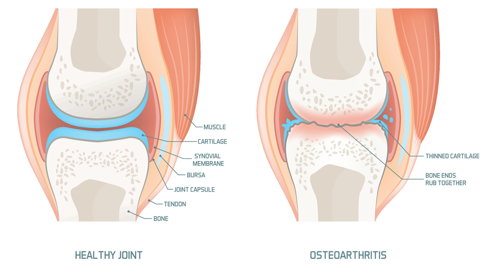 Knee Osteoarthritis